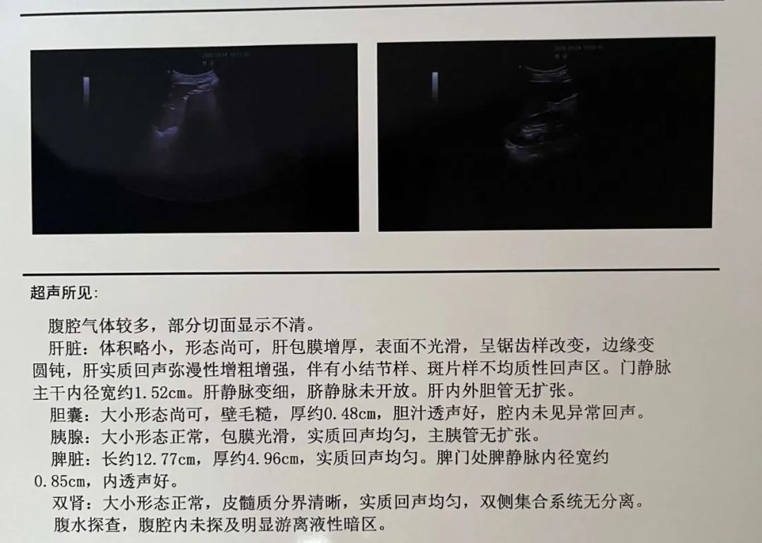 体检发现肝脏“小东西”莫慌张！医生：绝大多数是良性“占位” 但需专科评估
